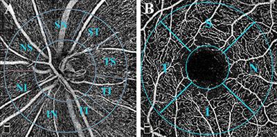 Change of Retinal Vessel Density After Lowering Intraocular Pressure in Ocular Hypertension